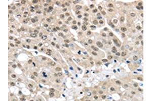 The image on the left is immunohistochemistry of paraffin-embedded Human breast cancer tissue using ABIN7130212(MED15 Antibody) at dilution 1/30, on the right is treated with fusion protein. (MED15 antibody)