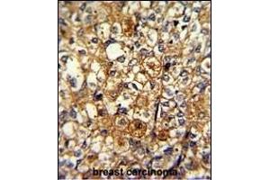Formalin-fixed and paraffin-embedded human breast carcinoma with ACTN1 Antibody (N-term), which was peroxidase-conjugated to the secondary antibody, followed by DAB staining. (ACTN1 antibody  (N-Term))