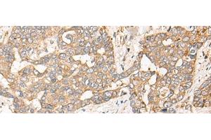 Immunohistochemistry of paraffin-embedded Human liver cancer tissue using CPNE3 Polyclonal Antibody at dilution of 1:40(x200) (Copine III antibody)