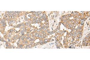 Immunohistochemistry of paraffin-embedded Human liver cancer tissue using CPNE3 Polyclonal Antibody at dilution of 1:40(x200)