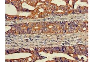 Immunohistochemistry of paraffin-embedded human colon cancer using ABIN7152131 at dilution of 1:100 (EIF2S1 antibody  (AA 276-315))