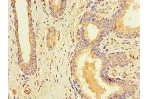 Immunohistochemistry of paraffin-embedded human prostate cancer using ABIN7168091 at dilution of 1:100 (Riboflavin Kinase antibody  (AA 1-154))