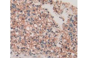 Used in DAB staining on fromalin fixed paraffin- embedded kidney cancer tissue (SPRY3 antibody  (AA 91-288))