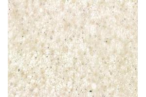ABIN6266423 and ABIN6277529 at 1/100 staining human astrocytoma by IHC-P.
