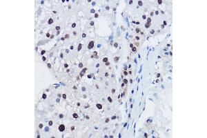Immunohistochemistry of paraffin-embedded human liver cancer using  Rabbit pAb (ABIN7265580) at dilution of 1:150 (40x lens). (ANAPC11 antibody  (AA 1-84))