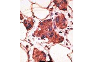 Formalin-fixed and paraffin-embedded human cancer tissue reacted with the primary antibody, which was peroxidase-conjugated to the secondary antibody, followed by AEC staining. (MAGEA9 antibody  (AA 171-198))