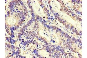 Immunohistochemistry of paraffin-embedded human colon cancer using ABIN7176555 at dilution of 1:100