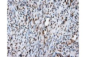 Immunohistochemical staining of paraffin-embedded Carcinoma of liver tissue using anti-FAHD2A mouse monoclonal antibody. (FAHD2A antibody)