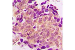 Immunohistochemical analysis of ALDOB staining in human breast cancer formalin fixed paraffin embedded tissue section. (ALDOB antibody  (Center))