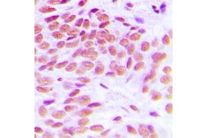 Immunohistochemical analysis of GATA1 staining in human breast cancer formalin fixed paraffin embedded tissue section. (GATA1 antibody  (Center))