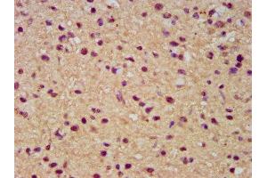 IHC image of ABIN7171980 diluted at 1:300 and staining in paraffin-embedded human glioma performed on a Leica BondTM system. (SLC19A2 antibody  (AA 209-285))