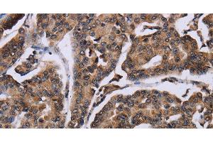 Immunohistochemistry of paraffin-embedded Human breast cancer using KIF1C Polyclonal Antibody at dilution of 1:60 (KIF1C antibody)