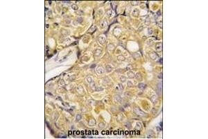 Formalin-fixed and paraffin-embedded human prostata carcinoma tissue reacted with TR antibody (Center ) (ABIN392820 and ABIN2842252) , which was peroxidase-conjugated to the secondary antibody, followed by DAB staining. (TRPM8 antibody  (AA 521-552))