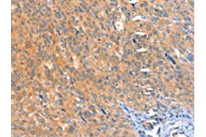 The image on the left is immunohistochemistry of paraffin-embedded Human cervical cancer tissue using ABIN7128174(ACOX3 Antibody) at dilution 1/25, on the right is treated with fusion protein.