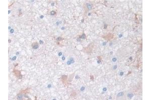 Detection of MMP3 in Human Glioma Tissue using Monoclonal Antibody to Matrix Metalloproteinase 3 (MMP3) (MMP3 antibody  (AA 363-477))