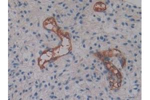 Detection of CYTH2 in Human Glioma Tissue using Polyclonal Antibody to Cytohesin 2 (CYTH2) (Cytohesin 2 antibody  (AA 1-390))