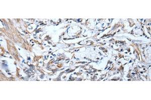 Immunohistochemistry of paraffin-embedded Human gastric cancer tissue using STRADA Polyclonal Antibody at dilution of 1:45(x200) (STRADA antibody)