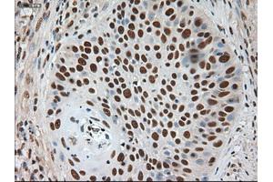 Immunohistochemical staining of paraffin-embedded Adenocarcinoma of breast using anti-Notch1 (ABIN2452671) mouse monoclonal antibody.