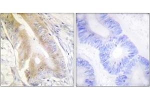 Immunohistochemistry analysis of paraffin-embedded human colon carcinoma tissue, using IREB1 (Ab-138) Antibody.