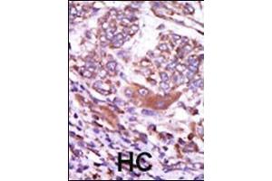 Formalin-fixed and paraffin-embedded human cancer tissue reacted with the primary antibody, which was peroxidase-conjugated to the secondary antibody, followed by AEC staining. (CAMK2D antibody  (C-Term))