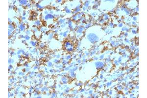 Formalin-fixed, paraffin-embedded human Histiocytoma stained with HLA-DR Monoclonal Antibody (SPM423). (HLA-DRB1 antibody)
