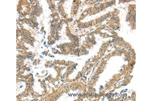 Immunohistochemistry of Human liver cancer using KCNG3 Polyclonal Antibody at dilution of 1:40 (KCNG3 antibody)
