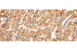 Immunohistochemistry of paraffin-embedded Human liver cancer tissue using ZMYND10 Polyclonal Antibody at dilution of 1:35(x200) (ZMYND10 antibody)