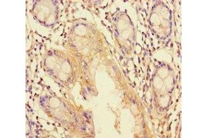 Immunohistochemistry of paraffin-embedded human colon tissue using ABIN7151266 at dilution of 1:100 (TRIM37 antibody  (AA 301-600))