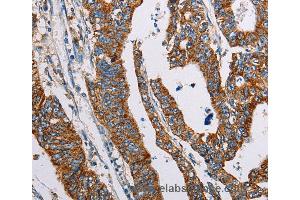 Immunohistochemistry of Human lung cancer using ALG2 Polyclonal Antibody at dilution of 1:35 (ALG2 antibody)