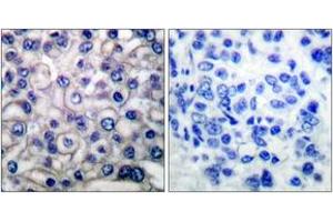 Immunohistochemistry analysis of paraffin-embedded human breast carcinoma tissue, using EGFR (Ab-693) Antibody.