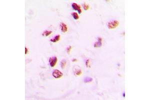 Immunohistochemical analysis of RAD50 staining in human lung cancer formalin fixed paraffin embedded tissue section. (RAD50 antibody  (Center))