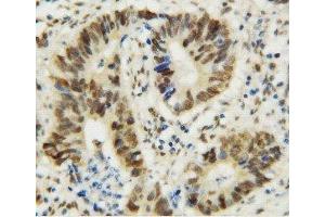 Anti-MTA1 antibody, IHC(P) IHC(P): Human Rectal Cancer Tissue (MTA1 antibody  (C-Term))