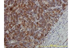 Immunoperoxidase of monoclonal antibody to CCT5 on formalin-fixed paraffin-embedded human lymphoma tissue. (CCT5 antibody  (AA 1-541))