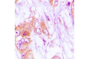 Immunohistochemical analysis of CDKL4 staining in human lung cancer formalin fixed paraffin embedded tissue section.
