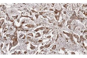 IHC-P Image Immunohistochemical analysis of paraffin-embedded human breast cancer, using Growth Hormone, antibody at 1:100 dilution. (Growth Hormone 1 antibody)