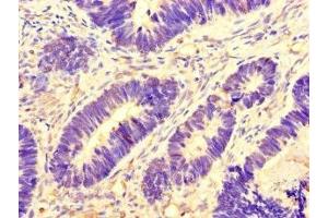 Immunohistochemistry of paraffin-embedded human ovarian cancer using ABIN7145075 at dilution of 1:100 (Aurora A antibody  (AA 1-131))