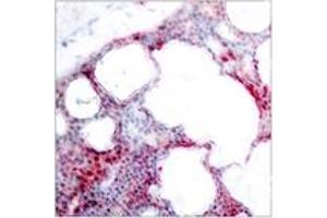 Immunohistochemistry analysis of paraffin-embedded human breast carcinoma, using ATF2 (Phospho-Ser62 or 44) Antibody. (ATF2 antibody  (pSer62))