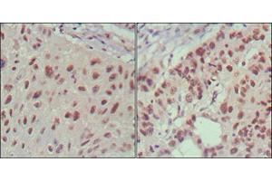 Immunohistochemical analysis of paraffin-embedded human lung cancer (left) and cervical carcinoma (right), showing nuclear localization using ISL1 mouse mAb with DAB staining. (ISL1 antibody)