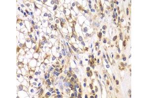 Immunohistochemistry of paraffin-embedded Human kidney cancer using SRPK1 Polyclonal Antibody at dilution of 1:200 (40x lens). (SRPK1 antibody)
