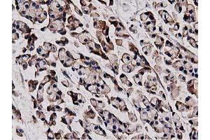 Immunohistochemical staining of paraffin-embedded Adenocarcinoma of Human colon tissue using anti-HDAC6 mouse monoclonal antibody.