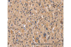 Immunohistochemistry of Human liver cancer using PPIF Polyclonal Antibody at dilution of 1:60 (PPIF antibody)