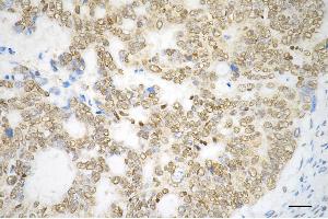 Immunohistochemistry was performed on paraffin-embedded human sigmoid colon carcinoma using PTBP1 antibody (ABIN7799882), 1:200).