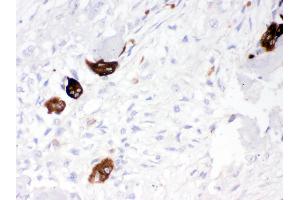 Cathepsin K was detected in paraffin-embedded sections of human osteosarcoma tissues using rabbit anti- Cathepsin K Antigen Affinity purified polyclonal antibody at 1 μg/mL. (Cathepsin K antibody  (AA 115-329))