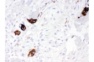 Cathepsin K was detected in paraffin-embedded sections of human osteosarcoma tissues using rabbit anti- Cathepsin K Antigen Affinity purified polyclonal antibody at 1 μg/mL.