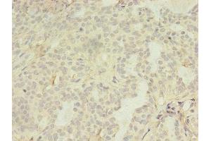 Immunohistochemistry of paraffin-embedded human breast cancer using ABIN7158260 at dilution of 1:100 (LILRA4 antibody  (AA 289-424))