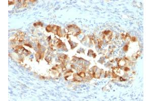 Formalin-fixed, paraffin-embedded human Endometrial Carcinoma stained with Mesothelin Mouse Monoclonal Antibody (MSLN/2131). (Mesothelin antibody  (AA 273-407))