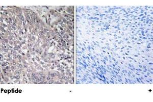 Immunohistochemical analysis of paraffin-embedded human cervix carcinoma tissue using ITPR1 polyclonal antibody . (ITPR1 antibody)