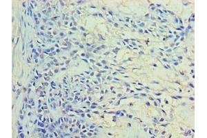 Immunohistochemistry of paraffin-embedded human breast cancer using ABIN7167221 at dilution of 1:100 (RAB11A antibody  (AA 2-213))
