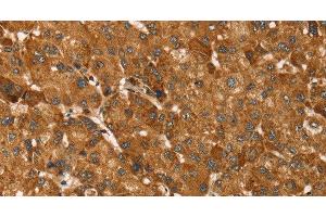 Immunohistochemistry of paraffin-embedded Human liver cancer tissue using TBC1D1 Polyclonal Antibody at dilution 1:45 (TBC1D1 antibody)