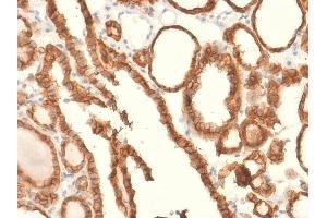 Formalin-fixed, paraffin-embedded human Thyroid Carcinoma stained with EpCAM Rabbit Recombinant Monoclonal Antibody (EGP40/2041R). (Recombinant EpCAM antibody  (Extracellular Domain))